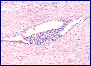 Abb. 4: Darstellung einer typischen vaskulären Invasion: Nachweis von Hodentumorzellen in einer Vene des tumortragenden Hodens