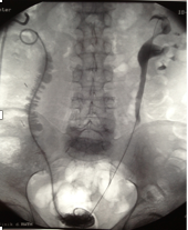 Ausscheidungsurografie eines rechtsseitigen Ureter-Ileum – Interponats