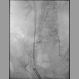 Platzierung eines Memokath – Stents im linken Ureter