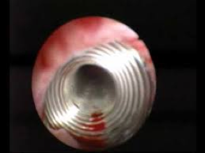 endoskopischer Blick auf den im Ureter liegenden Stent