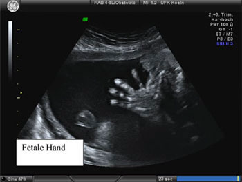 Fetale Hand