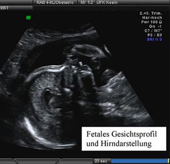 Fetales Gesichtsprofil und Hirndarstellung