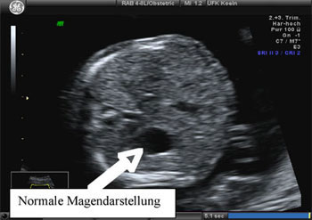 Normale Magendarstellung