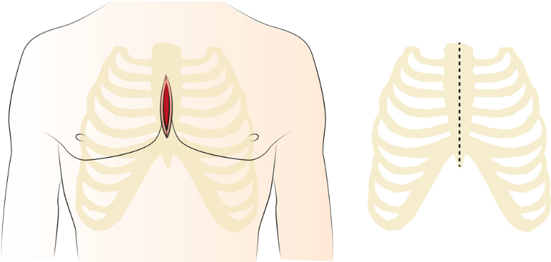 Mediane Sternotomie