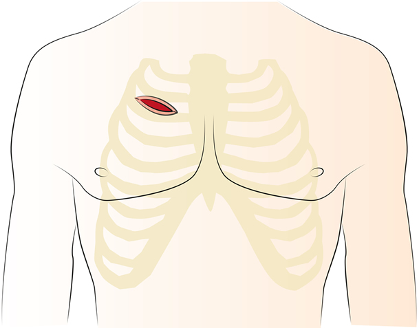 anteriore-thorakotomie-herzchirurgie-ukkoeln.jpg