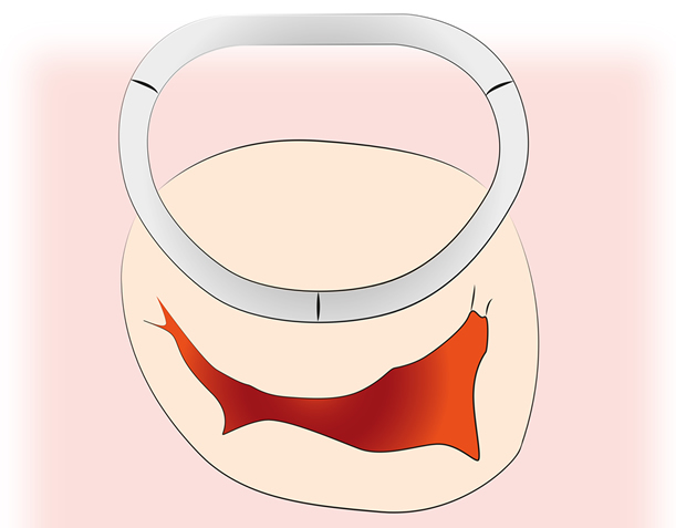 Anuloplastie-Ring