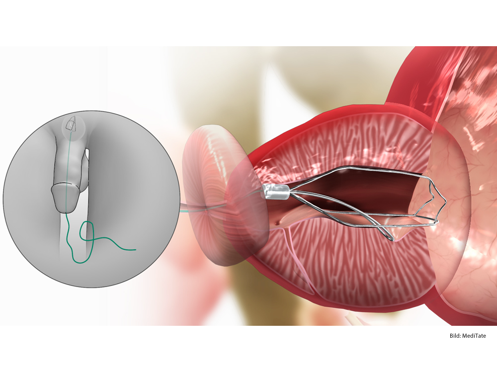 prostata ausschälung laser medicamente eficiente prostatita