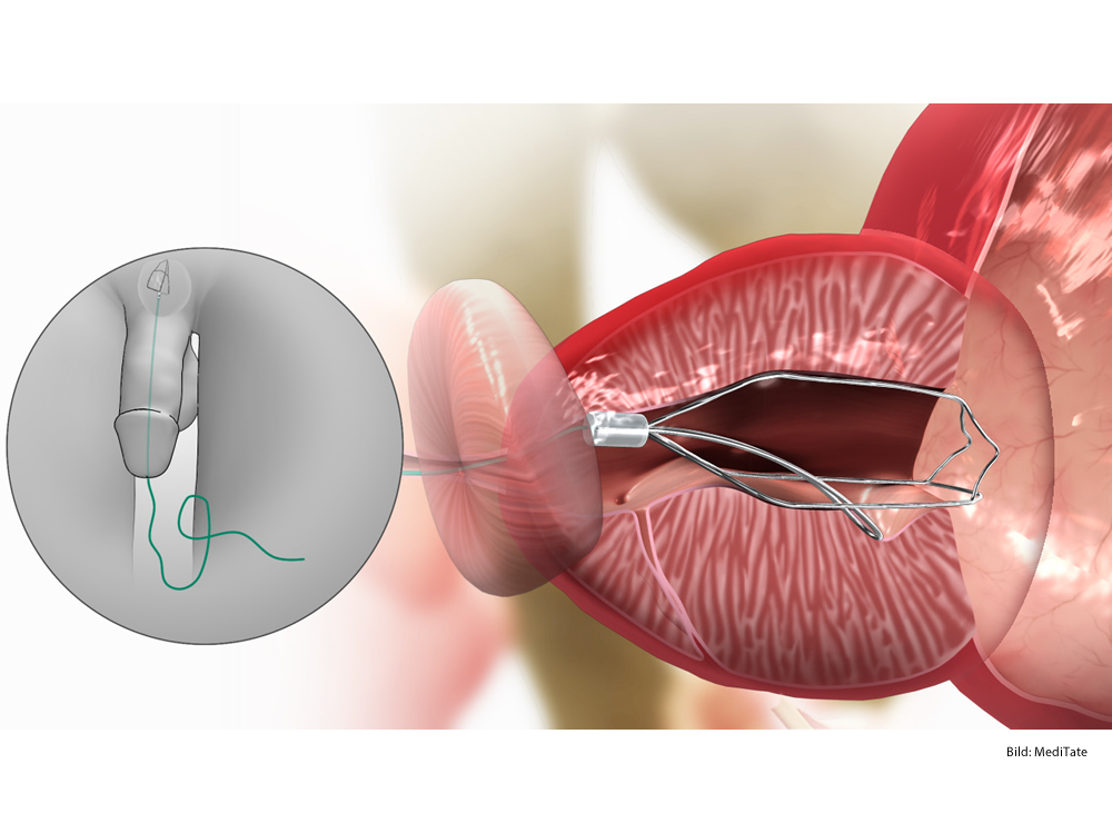 Enuclearea cu laser a adenomului de prostată și holep ce este