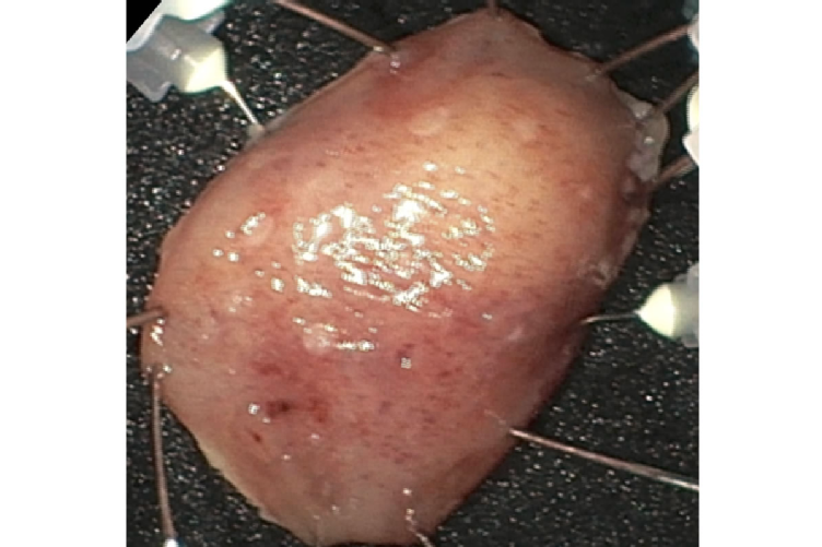 Subepithelialer Tumor im Magen (Frantz-Tumor, FTRD®-System, off-label im Magen), Quelle: Uniklinik Köln