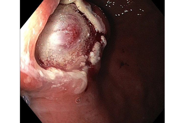 Metastase eines maligen Melanoms im Magen (GERDX™-System), Quelle: Uniklinik Köln