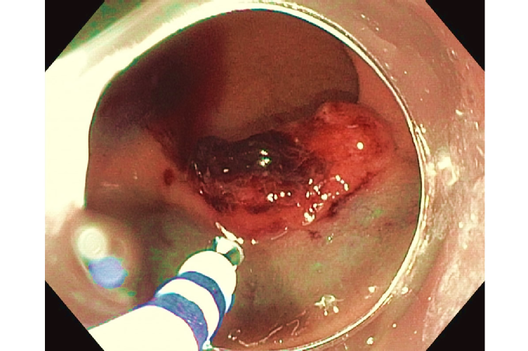 Rectumkarzinom – endoskopische Vollwandresektion mit anschließendem Verschluss mit Overstitch®-System, Quelle: Uniklinik Köln
