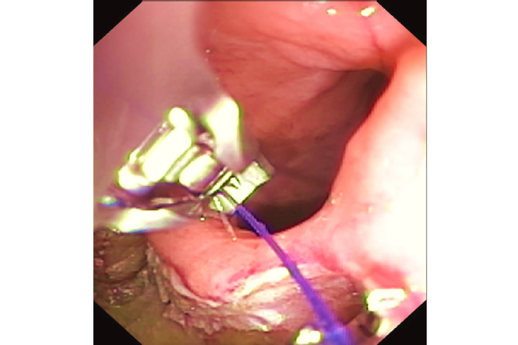 Rectumkarzinom – endoskopische Vollwandresektion mit anschließendem Verschluss mit Overstitch®-System, Quelle: Uniklinik Köln