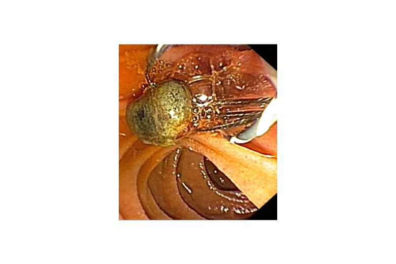 Choledocholithiasis (Gallengangsteine), Quelle: Uniklinik Köln