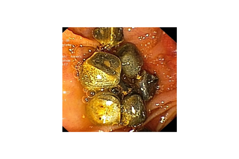 Choledocholithiasis (Gallengangsteine), Quelle: Uniklinik Köln