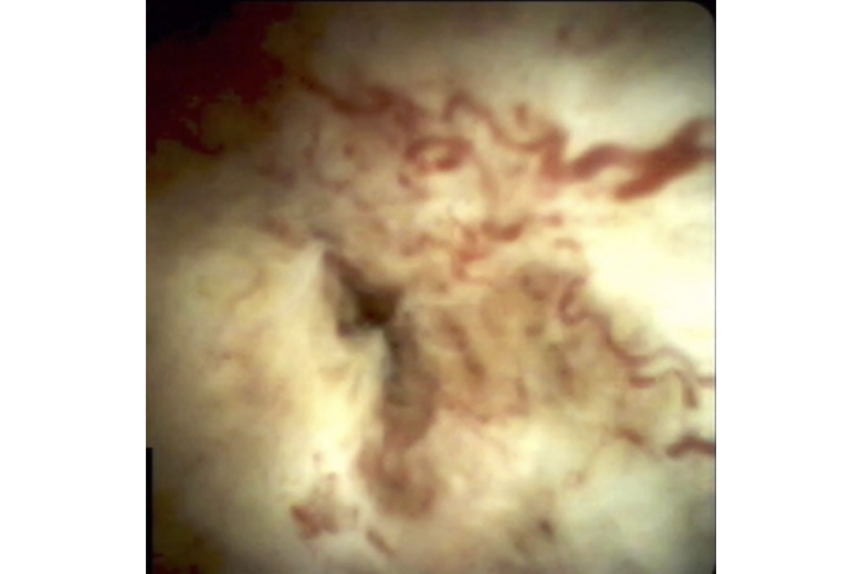 Cholangiozelluläres Karzinom (SpyGlass DS ®), Quelle: Uniklinik Köln