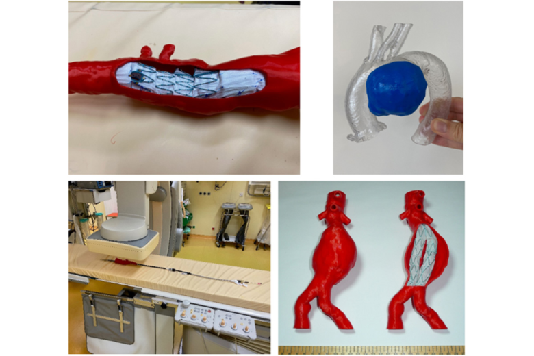 3D-gedruckte patientenspezifische Modelle der Aorta