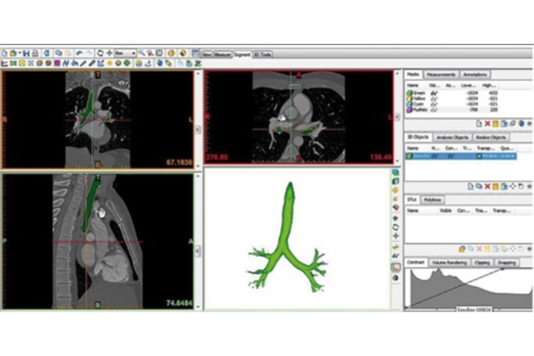 CT-Datensatz Trachea/Bronchien