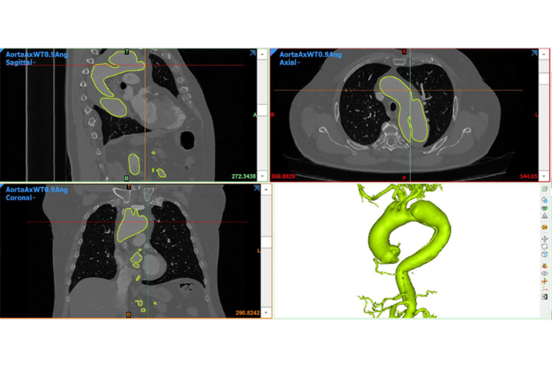 CT-Datensatz von Blutvolumen in der Aorta bei Patient mit Aortendissektion