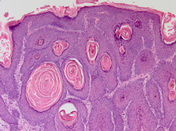 Histologische Färbung eines KHPV8-E7 induzierten Hauttumors, Bild: Baki Akgül