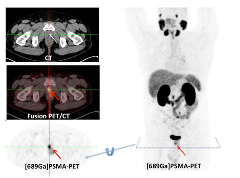 Was zeigt die Aufnahme? - PET-CT - Erkrankungen & Therapien | Nuklearmedizin Uniklinik Köln