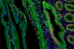 Verlust des Reparaturproteins „MLH1“ in Tumorgewebe eines Patienten mit erblichem Darmkrebs (HNPCC).