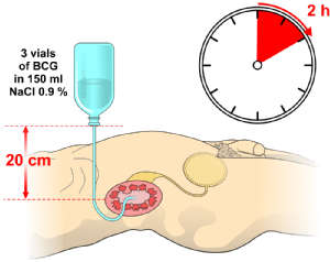 Applikationüber eine perkutane Nephrostomie