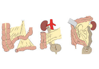 Schematische Darstellung des Ureter-Ileum-Interponats, welches sowohl den rechten als auch den linken Harnleiter ersetzen kann
