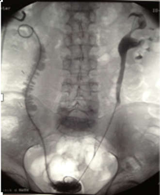 Ausscheidungsurografie eines rechtsseitigen Ureter-Ileum – Interponats