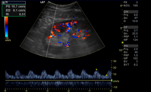 Niere nach Transplantation, Darstellung der Durchblutung im Ultraschall