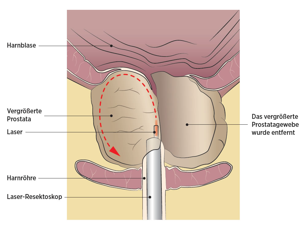 prostata verkleinern durch sport Krónikus prostatitis mkb 10