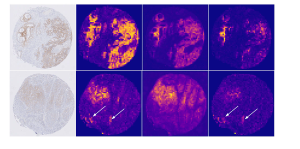 Heatmap-Visualisierung der Bildregionen, die ein neuronales Netz für die Vorhersage des HER2-Status benutzt, Quelle: Uniklinik Köln