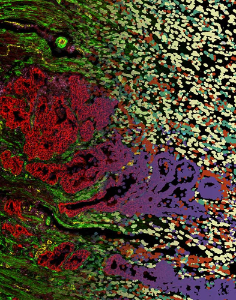 Esophageal adenocarcinoma analyzed with a multiplex metal-tagged antibody-directed Imaging Mass Cytometry with protein intensities (left) and segmented cells (right). It visualizes the interwoven architecture of cancer glands (left: red; right: purple) with cancer associated fibroblasts (left+right: green) and smooth muscle structures (left: green; right: yellow), macrophages (right: red), endothelial cells (left: yellow; right: orange), and T/B cells (left: purple; right: light blue). Image by Christoph Arolt