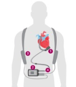 LVAD HeartMate 3