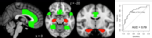 The cortex-to-hippocampus ratio discriminates non-AD co-pathologies. 