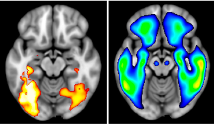 Neuronal activation in brain areas